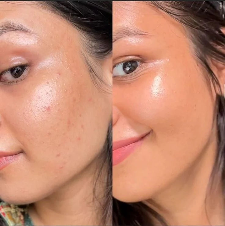 Fewer breakouts, smooth texture, no redness. I feel confident showing up exactly as I am.